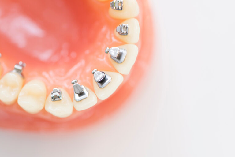 内側の矯正装置(リンガルブラケット)