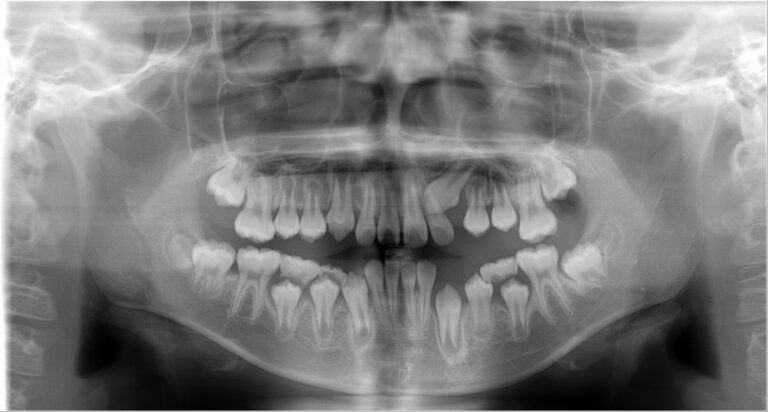 前歯がガタガタになっている、永久歯がなかなか萌えてこない時は、犬歯が骨の中で前歯の歯根を溶かしていることがあります。