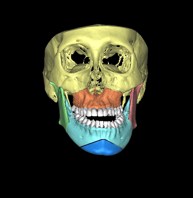 顎変形症をより詳しく!!