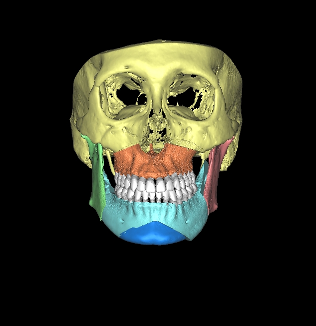 当院の顎変形症のシミュレーション vol.Ⅰ