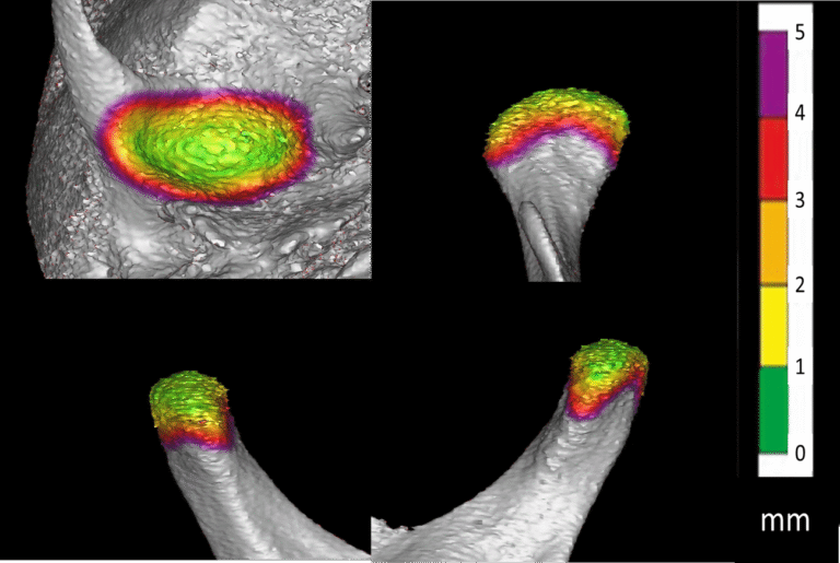 今では多分野の教科書に掲載! 当院考案のCT撮影による顎関節評価法 ― カラーマッピング法 ―