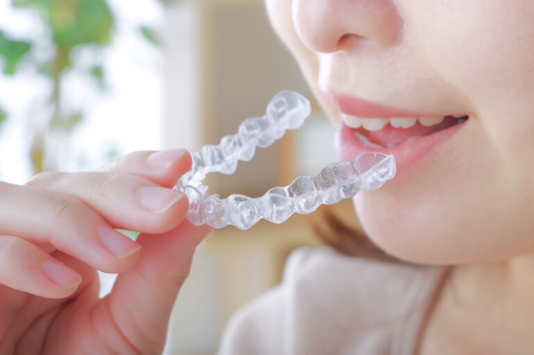 カスタムメイドのアライナー矯正