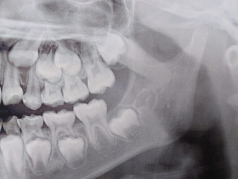 〈子どもの時だけ可能です〉 親知らずは、“たまご”のうちに取りましょう!
